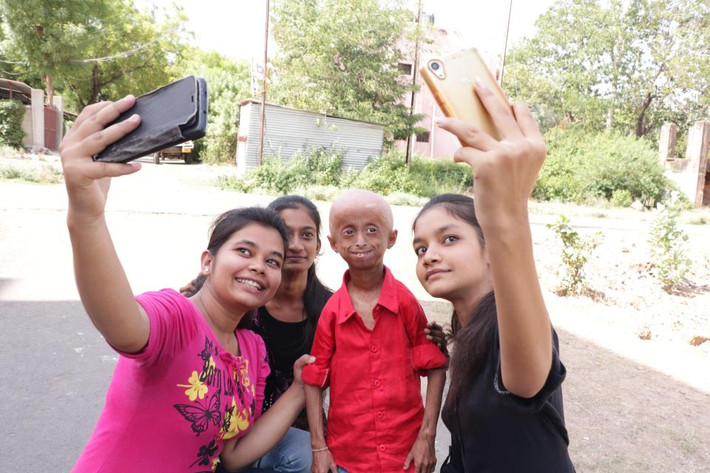 Cha của Shreyash, ông Arvind Barmate, một nhân viên chính phủ ở Madhya Pradesh, nói rằng, con trai ông đã bắt đầu phát triển các dấu hiệu của bệnh trên khắp cơ thể khi cậu bé lên 2. Ảnh: The Sun.