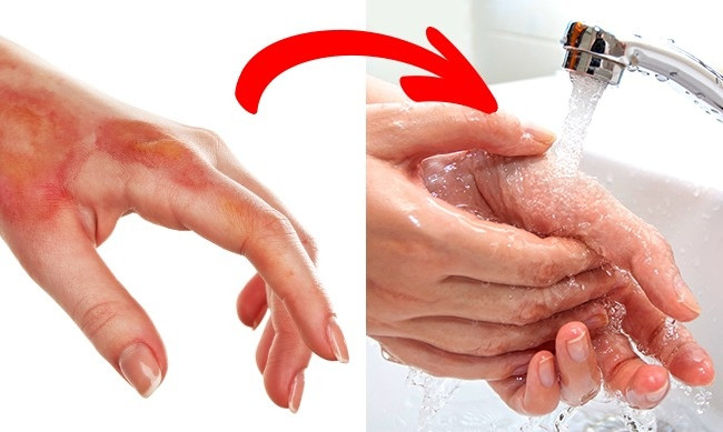 7. Rửa vết thương bằng oxy già, cồn: Nước oxy già phá hủy tế bào mô liên kết, khiến vết thương chậm lành, trong khi đó cồn đốt cháy các tế bào khỏe mạnh có thể gây ra đau, sốc và bỏng vết thương. Cách sơ cứu vết thương đúng: Rửa vết thương bằng nước sạch hoặc nước đun sôi để nguội, rồi bôi thuốc mỡ lên vết thương. Sau đó băng vết thương lại, thay băng ít nhất 1 lần/ngày. Ảnh: Brightside.