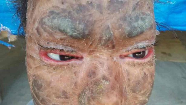 Do quá nghèo, gia đình của Yadav không đủ khả năng điều trị chuyên khoa để giảm bớt tình trạng bệnh tật cho cô bé. Vì vậy, các nhà từ thiện địa phương đã kêu gọi các bệnh viện trên toàn thế giới giúp đỡ cô bé. Rất may mắn, có một người ở Tây Ban Nha đã đồng ý điều trị cho Yadav miễn phí. Ảnh: SWNS.