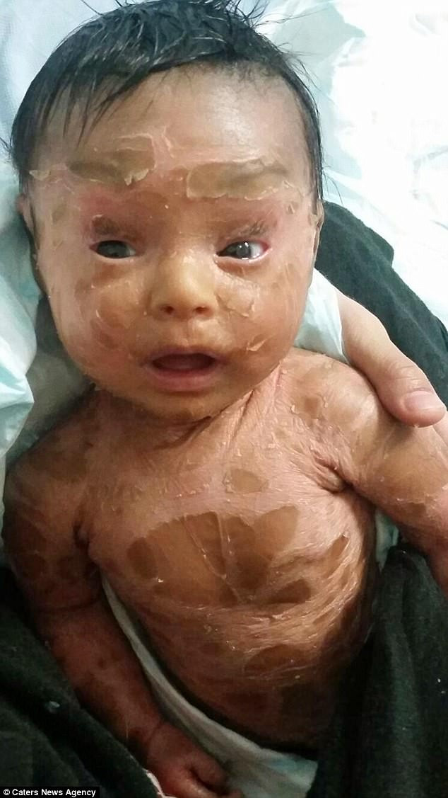 Cha mẹ của cô bé là Maira Bibi (21 tuổi) và Azmat Khan (25 tuổi), phải bôi kem dưỡng ẩm 4 lần một ngày để giữ cho da Maryam không bị rạn nứt. Họ đã làm hỏng hai chiếc máy giặt vì liên tục giặt quần áo và giường nệm của cô con gái nhỏ đáng thương. Ảnh: CNA.