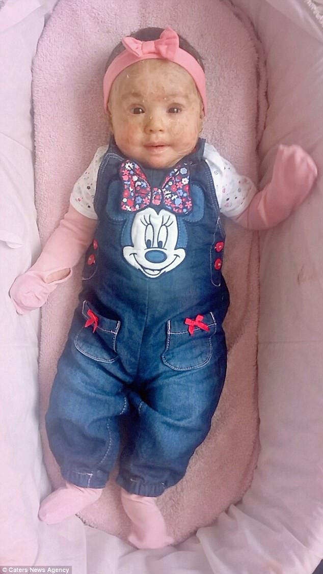 Sau đó, bác sĩ kết luận cô bé mắc chứng bệnh ichthyosis khiến da khô và hình thành vảy. Chị Maira cho biết: “Tôi thích gọi con gái mình giống như nàng tiên cá vì vẻ bề ngoài của bé. Dù con bé không bình thường như những đứa trẻ khác nhưng tôi đã dành trọn tình yêu cho nó ngay từ cái nhìn đầu tiên”. Ảnh: CNA.
