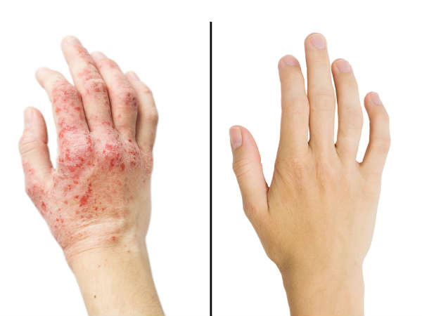 6. Chữa bệnh chàm Eczema: Eczema là một bệnh tự miễn dịch của da, gây khô da và ngứa. Dầu neem giúp làm giảm tình trạng khô và ngăn ngừa các nhiễm khuẩn thứ phát do vi khuẩn. Ảnh: Boldsky.