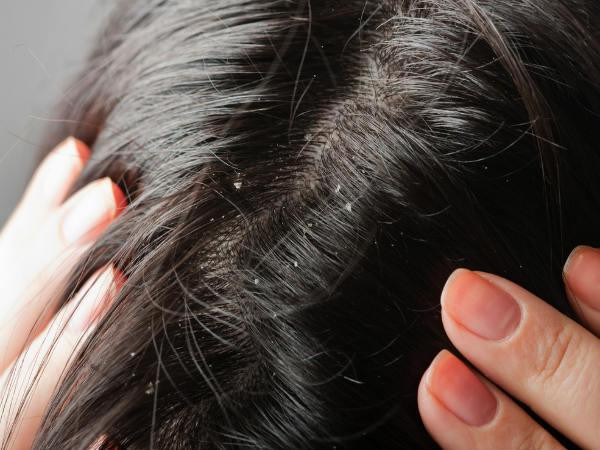11. Loại bỏ gàu và tóc gãy: Gàu là một hiện tượng các mảng bám bong tróc xuất hiện trên da đầu gây ngứa ngáy khó chịu và kém tự tin. Nguyên nhân của căn bệnh này do các loại nấm gây ra. Trong thành phần của tinh dầu neem có hoạt chất chống khuẩn và diệt nấm, chỉ cần kết hợp vài giọt tinh dầu neem cùng dầu gội đầu, bạn sẽ đánh bay gàu nhanh chóng, trả lại cho bạn mái tóc bóng mượt và sạch gàu hơn. Ảnh: Boldsky.