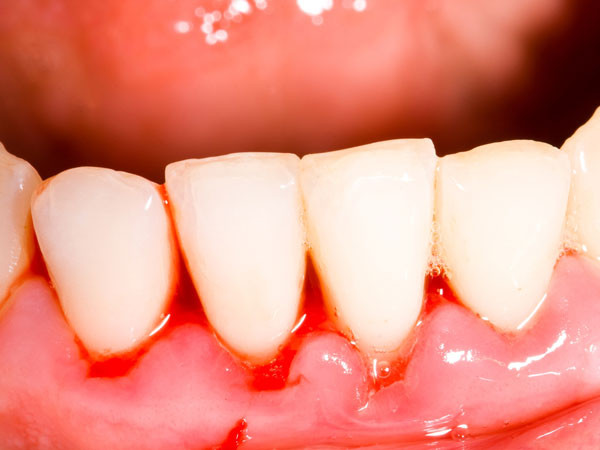 12. Điều trị bệnh về răng miệng: Súc miệng với dầu lá neem nguyên chất hoặc nhỏ vài giọt tinh dầu vào kem và đánh răng trực tiếp giúp đánh bay các mùi khó chịu trong hơi thở, chống lại các bệnh về răng miệng như: viêm nướu, viêm lợi, viêm nha chu, sâu răng… Ảnh: Boldsky.