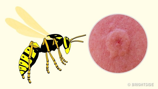Ong vò vẽ: Các triệu chứng khi bị ong vò vẽ đốt cũng giống như những triệu chứng từ loài ong thường. Khu vực bị chích đỏ và sưng tấy, nạn nhân cảm thấy đau, nóng và ngứa khủng khiếp. Ngoài ra, có thể bị xuất huyết trên da. Một con ong vò vẽ có thể đốt nhiều lần. Cũng giống như khi bị ong mật chích, điều quan trọng là phải xem nạn nhân có bị dị ứng nọc ong hay không. Ảnh: Brightside.