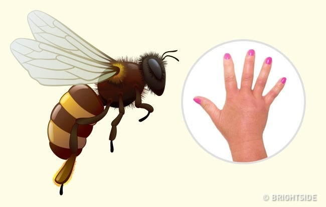 Ong bắp cày: Nếu bị ong bắp cày đốt, khu vực đó sẽ bị tấy đỏ và sưng lên nghiêm trọng. Bên cạnh đó, còn xuất hiện những vết loang. Nạn nhân có thể cảm thấy vô cùng đau đớn bởi nóc của ong bắp cày rất độc, có chứa các chất histamine và acetylcholine. Nếu nạn nhân cảm thấy lạnh ở các chi, tai và môi trở nên tái nhợt hoặc gặp các vấn đề về hô hấp, phải đưa đến bệnh viện ngay lập tức. Ảnh: Brightside.