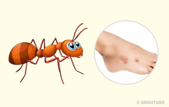 Kiến: Hầu hết các loài kiến không gây nguy hiểm cho người. Tuy nhiên, kiến lửa đỏ có thể gây nhiều rắc rối. Vết mụn mủ xuất hiện trên các vết cắn mà sau này sẽ biến thành vết sẹo. Vết cắn của kiến ít nguy hiểm hơn. Nó trông giống như vết muỗi chích. Một vết nhỏ màu hồng xuất hiện trong khu vực bị cắn gây ngứa trong một thời gian dài. Ảnh: Brightside.