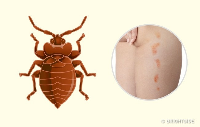 Rệp: Thoạt nhìn, những vết cắn trên da trông giống như bị bọ chét cắn, muỗi đốt hoặc dị ứng. Da trở nên ửng đỏ, sưng và ngứa. Tuy nhiên, có một cách để nhận ra đó là vết đốt của những con rệp. Các vết cắn của rệp rất gần với nhau và trông giống như những con đường nhỏ trên da, thường gây đau đớn hơn muỗi đốt. Bạn có thể quan sát rõ hơn vào buổi sáng sau khi bị những con rệp đốt vào buổi tối hôm trước. Ảnh: Brightside.