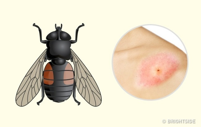 Ruồi trâu: Ruồi trâu là một loại ruồi lớn thường đốt và hút máu gia súc. Tuy nhiên, chúng cũng cắn người rất đau. Ban đầu, vết đốt nổi đỏ không quá 1mm. Sau đó, bắt đầu sưng lên và ngứa. Ruồi trâu thường truyền các bệnh khác nhau như bệnh tularemia (bệnh nhiễm khuẩn cấp tính do vi khuẩn francisella tularensis gây ra) và bệnh than, nhưng hầu hết chúng thường tấn công gia súc nhiều hơn con người. Ảnh: Brightside.