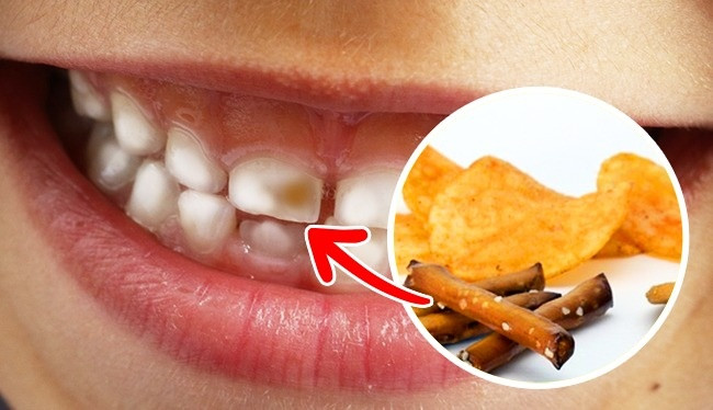 7. Bim bim: Các loại bim bim chứa carbohydrate nhanh chóng biến thành glucose dưới ảnh hưởng của nước bọt, hình thành những vết ố vàng trên răng. Sau khi bạn ăn bim bim, sẽ còn lại những mảng bám răng, do đó, đừng quên xúc miệng bằng nước sau khi bạn có một bữa ăn nhẹ. Ảnh: Pixabay.
