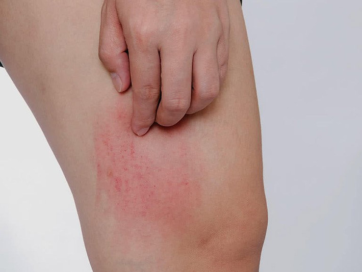Biểu hiện 2: Trên da nổi mụn. Thực chất không chỉ vùng kín của nam giới mà ở các bộ phận khác, rận mu cũng có thể gây ra hiện tượng này. Cần biết rằng, rận mu xuất hiện ở bộ phận nào thì sẽ bộ phận đó sẽ nổi một vài nốt mẩn đỏ nhỏ, thậm chí bị nổi vảy máu, bị dị ứng và có hiện tượng nổi mụn trên da.