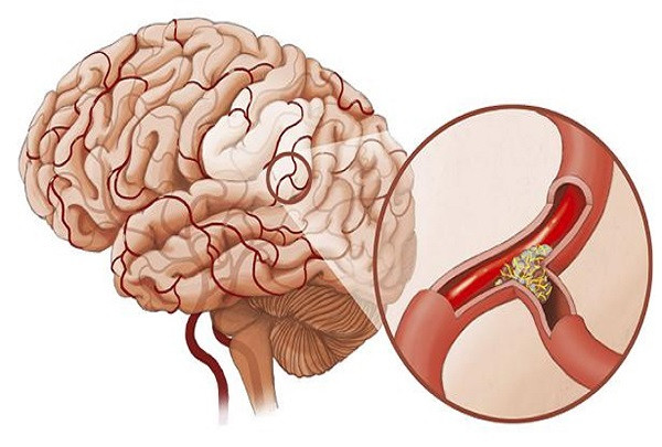 Nếu không muốn bị bệnh, bạn phải điều chỉnh thói quen ăn uống của mình. Ngoài ra, tập thể dục hợp lý, bổ sung nước nhiều hơn và chú ý duy trì trí lực có thể giảm thiểu nguy cơ nhồi máu não.