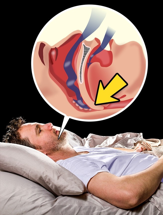Hiện tượng ngừng thở trong lúc ngủ, đây là hiện tượng xảy ra đột ngột và người bị thường tỉnh dậy ngay. Người nào mắc phải tình trạng này, chất lượng giấc ngủ sẽ bị suy giảm giảm, não luôn cảm thấy đói khát oxy, rất khó khăn ngủ đủ giấc. Áp lực động mạch cũng dao động, gây ra các vấn đề về tim. (Nguồn Brightside)