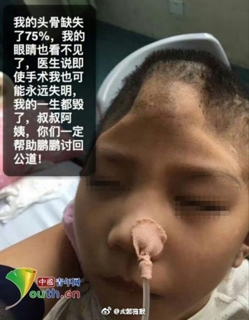 Mới đây, dư luận Trung Quốc đang vô cùng bức xúc với vụ việc mẹ kế ngược đãi con riêng của chồng tàn bạo, khiến cậu bé đáng thương, mới chỉ 6 tuổi đã bị chấn thương sọ não tới 75%, gãy xương sườn, tổn thương võng mạc, vỡ hàm trên và vô số các vết thương kinh khủng khác. (Nguồn Sina)
