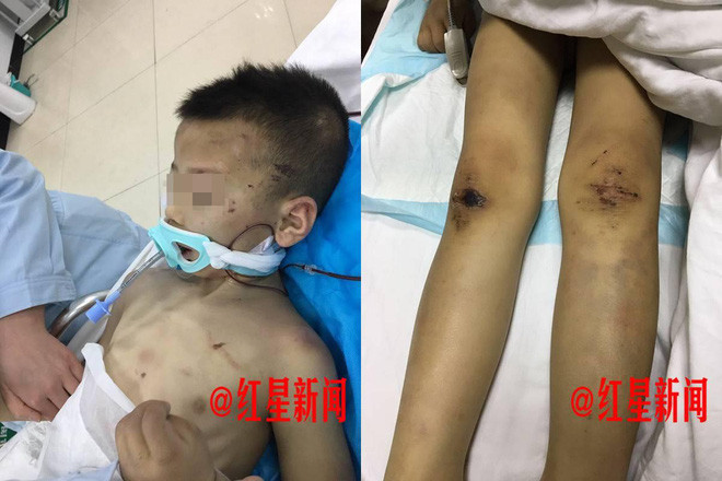 Hiện tại, Bằng Bằng sẽ phải chuẩn bị phẫu thuật liên tục, chi phí cũng rất lớn. Rất nhiều mạnh thường quân đã đứng ra từ thiện đồng thời kêu gọi quyên góp cho cậu bé. Cậu bé cũng chỉ ăn được thức ăn lỏng và thường đau đớn không thể ngủ được, phải dỗ dành rất nhiều. Nếu như hồi phục lại, Bằng Bằng cũng sẽ phải cực kỳ nỗ lực trong việc phục hồi các chức năng vật lý. (Nguồn Sina)