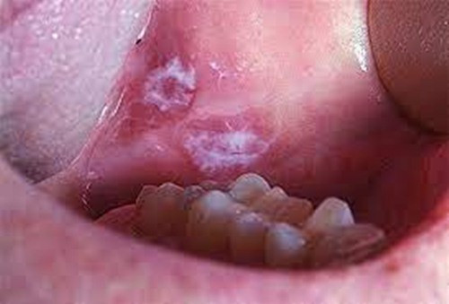 Sưng không rõ nguyên nhân, vón cục, bong tróc và thay đổi màu sắc của màng nhầy xuất hiện trong khoang miệng: Ví dụ như bạch sản, ban đỏ, liken phẳng hoặc đốm dạng lưới,… cũng cần phải cảnh giác.