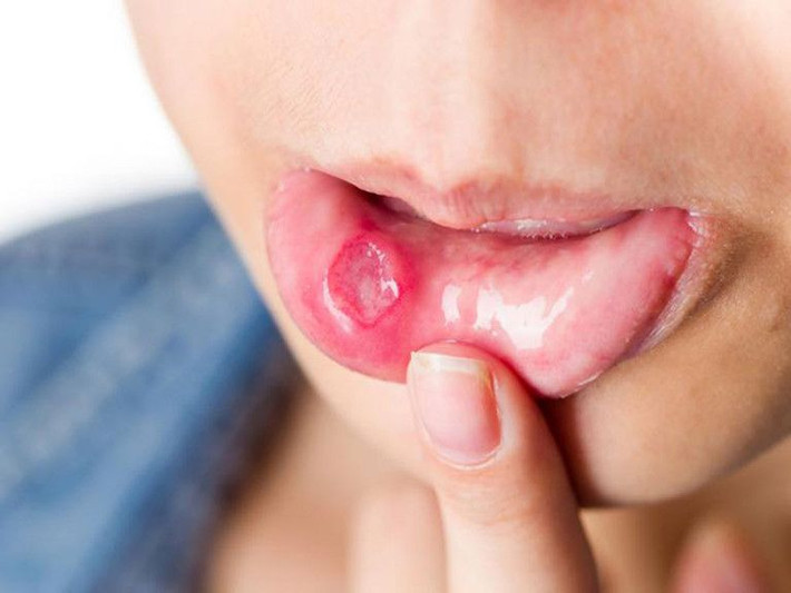 Tê miệng rõ ràng và hạn chế mở miệng: Bình thường, chúng ta có thể đưa ba ngón tay ngang vào giữa răng cửa hàm trên và răng cửa hàm dưới, lúc này miệng khoảng 5 cm. Nếu chỉ đưa được hai ngón tay vào là lâm sàng nhẹ, hạn chế nếu chỉ đưa một ngón tay vào miệng, miệng bị hạn chế đóng mở thì bạn phải rất lưu ý.
