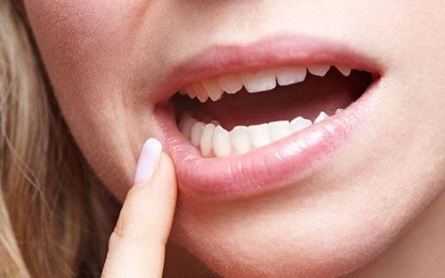 Tất nhiên, hạn chế há miệng không có nghĩa là bạn bị ung thư miệng. Một số chấn thương hoặc rối loạn khớp cũng có thể gây ra tình trạng há miệng hạn chế. Song, đó cũng là biểu hiện tiền ung thư, vì vậy nếu có triệu chứng hạn chế há miệng, hãy đến bệnh viện để chẩn đoán nguyên nhân kịp thời.