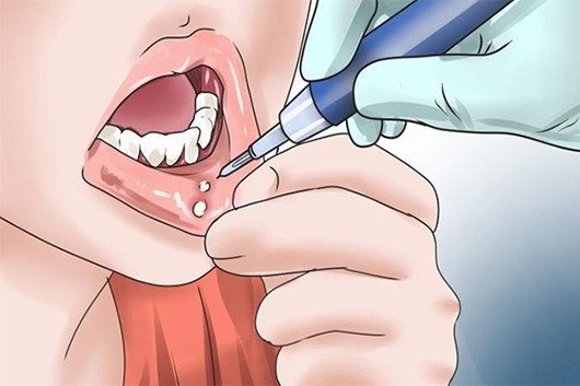 Ung thư được xác định bằng cách xem khu vực đó có bị viêm hay không hoặc nó có bị chèn ép vào các dây thần kinh hay không. Vì vậy, đừng mất cảnh giác chỉ vì khối u gây đau đớn và đánh giá nó không phải là ung thư.