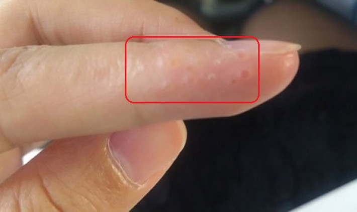4. Ngón tay mọc nhiều mụn nước: Mọi người thường nghĩ mình bị nấm nên không chú ý. Tuy nhiên, nổi mụn ở ngón tay có thể là dấu hiệu gan của mọi người đang tổn thương và phát đi tín hiệu cầu cứu. Đặc biệt, mụn nước mọc thành từng cụm, gây ngứa ngáy hoặc liên tục mọc lại sau khi bôi thuốc thì phải đi khám ngay.
