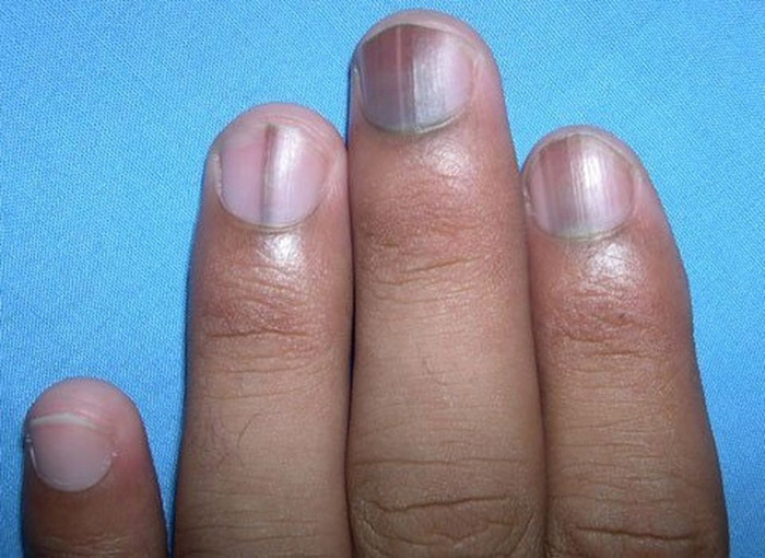 Tình trạng sưng càng nặng chứng tỏ dạ dày càng tích tụ nhiều độc tố, có thể kèm theo viêm ruột mãn tính hoặc chứng khó tiêu và các bệnh đường tiêu hóa nghiêm trọng khác. Còn việc ngón tay tím tái, đau nhức có thể là do khí huyết tắc nghẽn, không cung cấp đủ khí cho phổi, nên đi khám để được tư vấn chính xác và kỹ càng hơn.