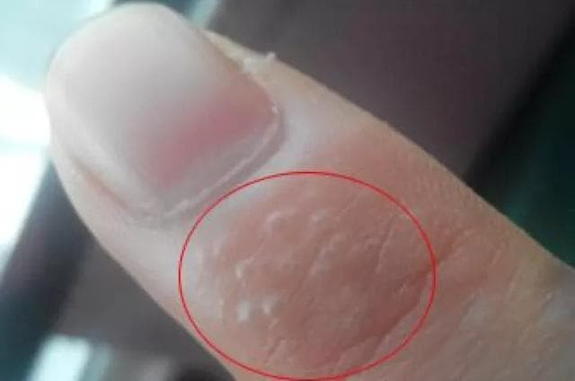 Hiện tượng này có thể do gan đã tích tụ quá nhiều độc tố và trở nên quá tải. Nếu ở giai đoạn mắc các bệnh về gan, đặc biệt là ung thư gan thì mụn nước sẽ đi kèm với vàng da. Dù nặn hết dịch trong mụn thì vết thương cũng rất lâu lành và thường bị gây bong tróc da thời gian dài.