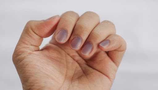 6. Đầu ngón tay sưng, tím tái: Khi không va đập hay chấn thương gì mà phần đầu ngón tay và móng tay đột nhiên căng phồng, tím tái thì mọi người nên cẩn trọng với các bệnh dạ dày, đường tiêu hóa, khí huyết tắc nghẽn.