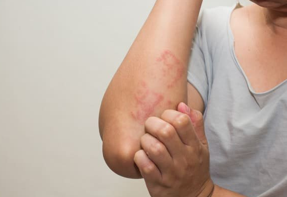 Thứ ba, không tiêm vắc xin COVID-19 nếu đang bị nhiễm trùng, sốt (≥ 37,5°C). Không tiêm vắc xin COVID-19 khi có các vấn đề về xuất huyết/chảy máu hoặc bầm tím, hoặc đang dùng thuốc chống đông máu.