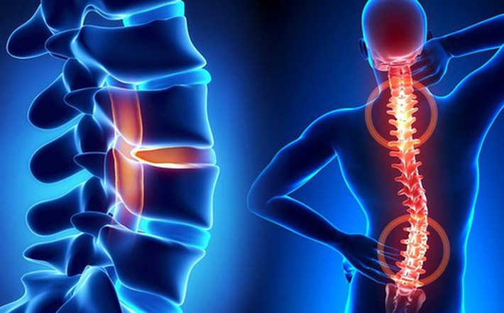 Nguyên nhân gây ra bệnh thiếu máu não: Do vấn đề cột sống, khi cột sống của bạn bị tổn thương hoặc có bệnh, chúng sẽ làm chèn lên các mạch máu và ảnh hưởng đến việc cung cấp máu lên não.