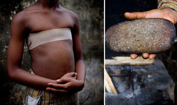 Các bé gái ở Cameroon và một số quốc gia châu Phi gây chú ý khi phải chịu đựng sự đau đớn khi thực hiện hủ tục "là ngực".