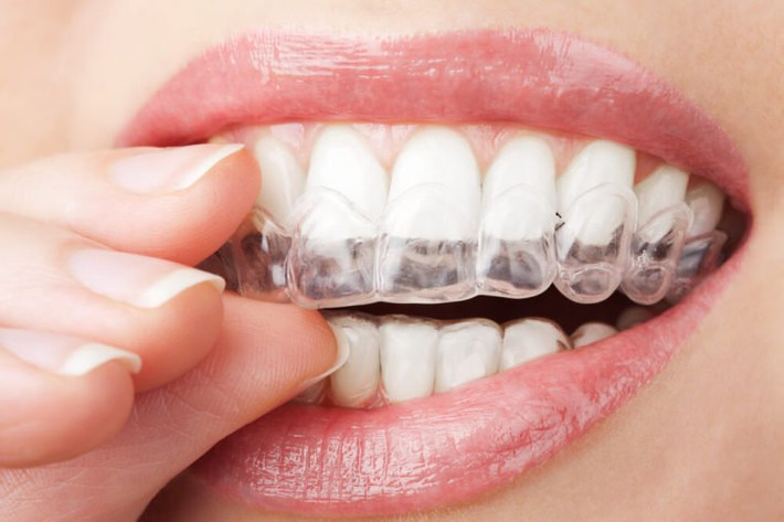 Trám chân răng: Nếu bạn đã trám chân răng, bạn có thể nên xem xét một chất trám bảo vệ răng khỏi vi khuẩn.