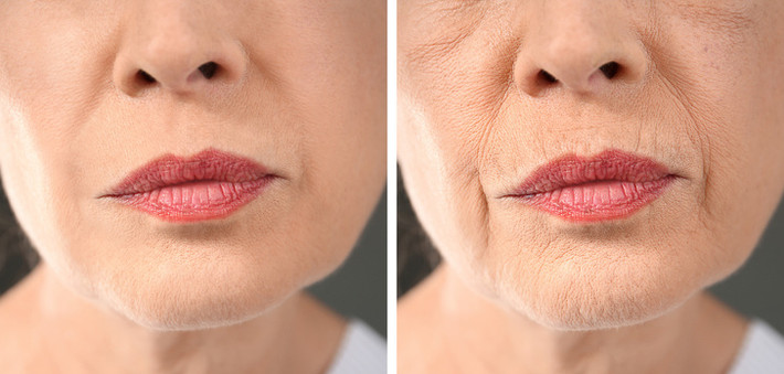 Nếp nhăn bắt đầu xuất hiện: Ở độ tuổi 30, bạn có thể dễ dàng nhận ra dấu hiệu lão hóa trên da. Các nguyên bào sợi là những cỗ máy sản sinh collagen trong da. Khi bước sang tuổi 30, số lượng collagen sụt giảm, khiến da nhanh lão hóa, nhăn.