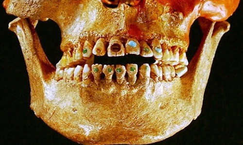Từ khoảng 2.500 năm trước, những thổ dân ở châu Mỹ đã biết cách gắn đá quý vào răng để làm đẹp. Kết luận này được các chuyên gia đưa ra sau khi nghiên cứu, phân tích vài nghìn mẫu răng gắn đá quý mà họ thu thập được.