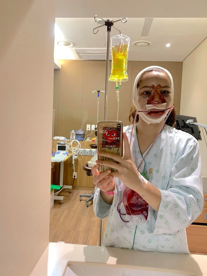 Lưu Đê Ly tự chụp lại gương mặt của mình sau khi phẫu thuật 6 điểm trên gương mặt.