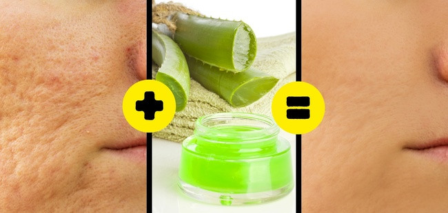 Lá nha đam có chứa một chất giống như gel, thúc đẩy quá trình tái tạo da. Thoa gel nha đam tươi ngay trên vết sẹo, massage theo vòng tròn. Để trong 30 phút và rửa sạch. Áp dụng hai lần một ngày.