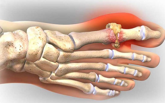 Bệnh gút hay còn gọi là bệnh gout, là một loại viêm khớp đột ngột gây sưng đỏ và đau ở các khớp. Bệnh xảy ra khi tinh thể acid uric lắng đọng trong các khớp của cơ thể, đặc biệt là ngón chân cái, mắt cá chân, đầu gối, khuỷu tay, cổ tay và ngón tay.