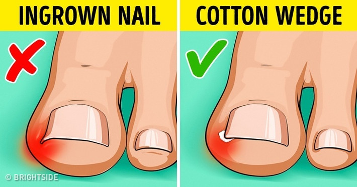 Để nâng móng chân của bạn lên một chút, hãy đặt một miếng nêm bông nhỏ kẹp vào giữa móng chân và da. Cố gắng thay đổi thường xuyên bông nêm, đặc biệt là sau khi ngâm chân trong bồn.