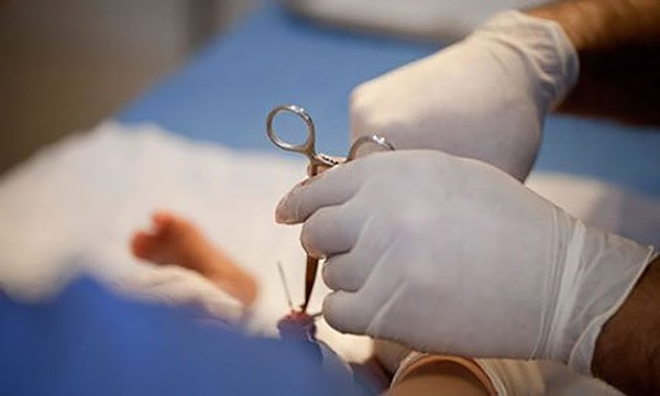 Tại một số quốc gia khi những bé trai chào đời sẽ được mặc định thực hiện tiểu phẫu cắt bao quy đầu. Theo các bác sĩ cho biết việc cắt bao quy đầu sẽ giúp các bé vệ sinh cậu nhỏ dễ dàng hơn từ đó ngừa được nguy cơ mắc bệnh.