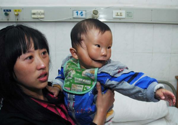 Cậu bé Khang Khang ở tỉnh Hồ Nam, Trung Quốc từ lúc sinh ra đã mang khuôn mặt méo mó được y học gọi là chứng nứt ngang mặt. Ảnh: Wonderlist.