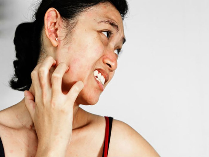 Phát ban da: Một trong những phản ứng có hại do bổ sung quá nhiều vitamin C là phát ban da. Điều này xuất hiện chủ yếu ở trẻ sơ sinh. Nó thể hiện ra bên ngoài giống như một phản ứng dị ứng.