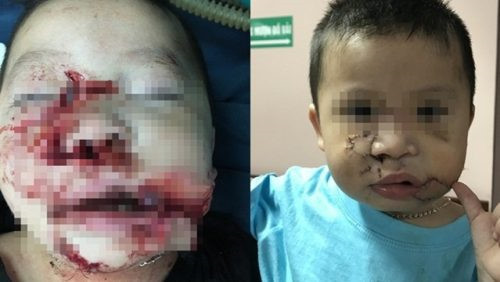 Hồi tháng 5/2018, các bác sĩ khoa Tạo hình – Sọ mặt, Bệnh viện Nhi Trung ương điều trị thành công cho một bé trai (2 tuổi, ở Ba Vì, Hà Nội) bị chó cắn dập nát mặt.