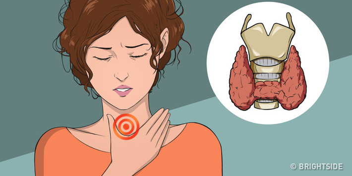 Nếu bạn gặp một số triệu chứng cảnh báo tuyến giáp trục trặc sau, hãy đến gặp bác sĩ càng sớm càng tốt. Suy giáp là một tình trạng trong đó tuyến giáp không sản xuất đủ hormone tuyến giáp. Thiếu i-ốt là một trong những nguyên nhân phổ biến nhất gây suy giáp.