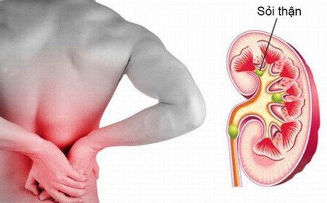 Sỏi thận và suy thận: Khi bạn nhịn tiểu, cặn canxi không được đào thải và lưu lại tạo thành sỏi và phải mất thời gian khá dài để chữa trị hoặc phải mổ để gắp sỏi ra.