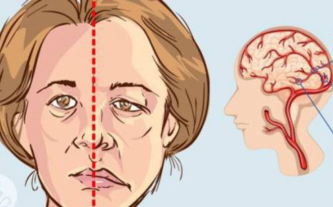 Dấu hiệu ở mắt: Tai biến mạch máu não có thể gây ra ảo ảnh kép, mất thị lực một bên mắt, hoặc thị lực mờ ảo. Một cuộc khảo sát 1.300 người ở Anh, họ đều cho rằng đột quỵ ảnh hưởng nghiêm trọng tới thị lực. Người bệnh khi nhận thấy mình có dấu hiệu này thì nên yêu cầu được cấp cứu ngay.