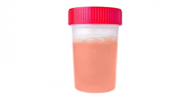 4. Nước tiểu màu đỏ: Nếu bạn nhận thấy điều này xảy ra, có thể là do nước tiểu của bạn có máu rò rỉ trong đó. Đây chính là một trong những dấu hiệu cảnh báo bệnh suy thận. Ảnh: Internet.
