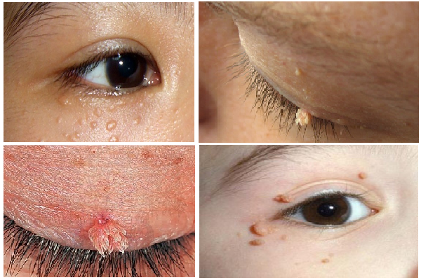 Vùng mắt cũng có thể là nơi phát bệnh sùi mào gà với những dấu hiệu như trên. Ảnh: Heathplus.