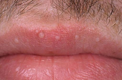 Nốt sùi mào gà cũng có thể mọc trên môi người nhiễm bệnh. Đây là hình ảnh thời điểm giai đoạn đầu của bệnh. Ảnh: PKbenhxahoi.