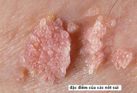 Cận cảnh những nốt sùi trên da thịt nhìn không khác gì như chiếc mào gà. Ảnh: ĐK Baoanh.