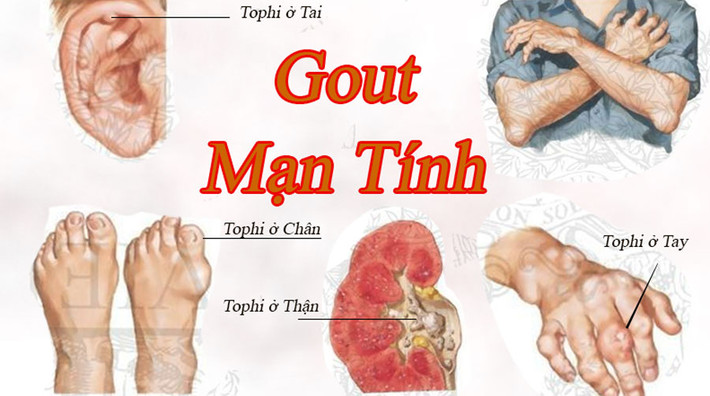 Người bị bệnh gout, viêm đau xương khớp: ốc là một trong những loại thực phẩm khắc tinh với những người bệnh này. Nếu không biết mà vô tình ăn quá nhiều ốc bệnh sẽ phát tác và gây đau đớn cho người bệnh nhiều hơn. Ảnh: Infonet.