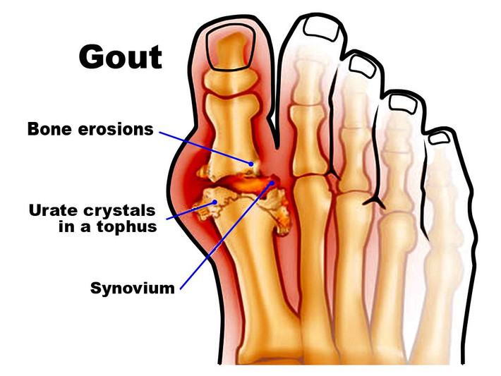 Quả cây trứng cá giảm đau cho bệnh nhân Gout: nếu chỉ sử dụng trứng cá sẽ không thể chữa khỏi hoàn toàn bệnh Gout nhưng ănquả cây trứng cá đều đặn 9-12 quả mỗi ngày có thể giảm nhẹ cơn đau do bệnh gout gây ra. Ảnh: Nấm lim xanh.